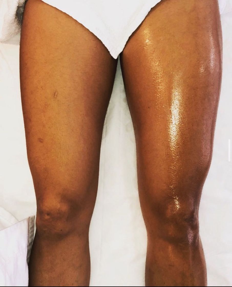 Social Resultado drenagem linfática 